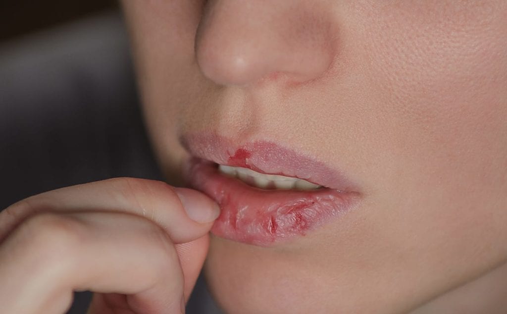 A woman picks at the skin of her lips due to compulsive skin picking
