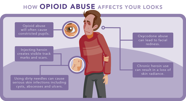 How Opioids Affect Your Looks