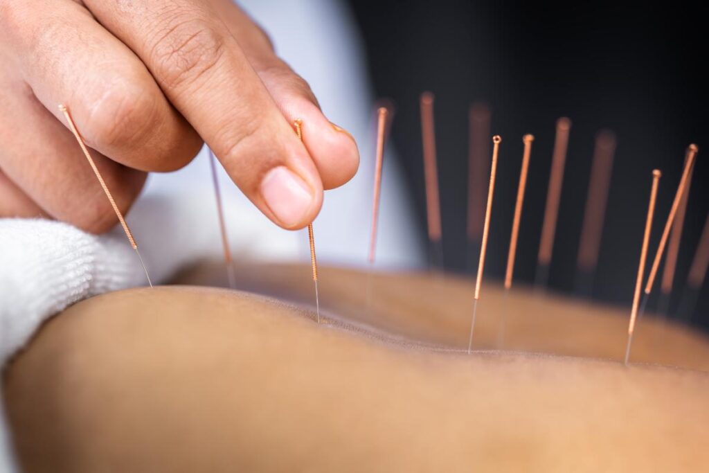 an example of acupuncture for addiction recovery
